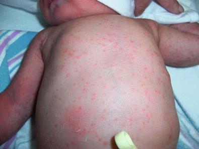 Figure 14.3, Congenital candidiasis.