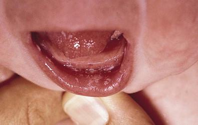 Figure 14.6, White plaques of oral thrush.