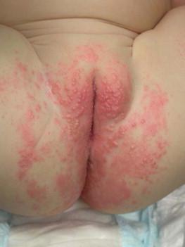 Figure 14.8, Candidal diaper dermatitis.