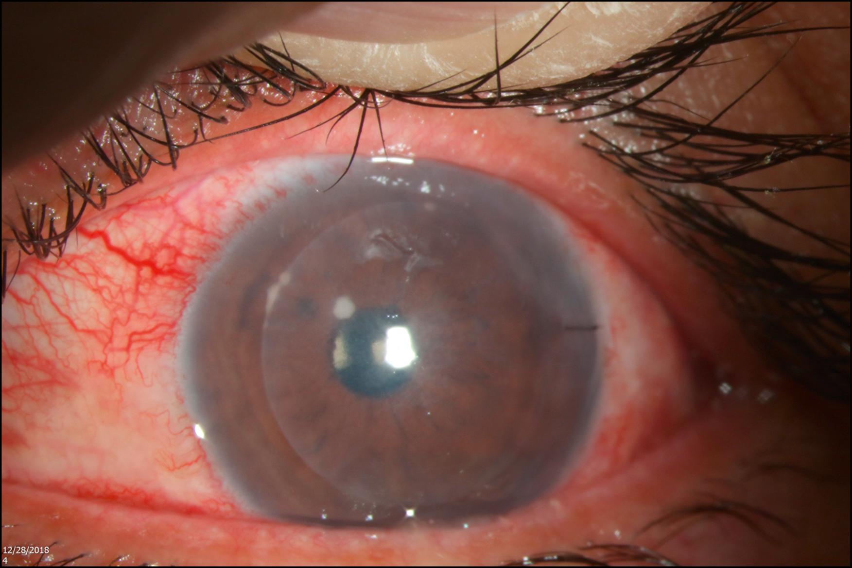 Fig. 81.1, Candida in interface of Descemet stripping automated endothelial keratoplasty graft.