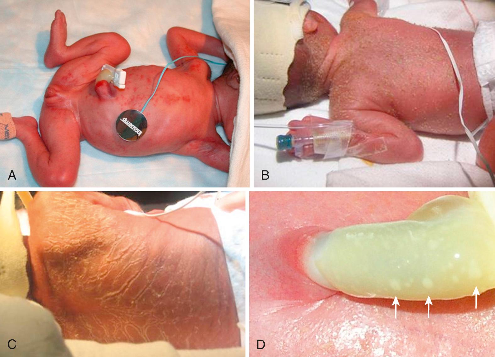 Fig. 49.7, Congenital cutaneous candidiasis. A, Macular papular rash. B, Dry, flaky rash. C, Dry, cracking scaly rash. D, White plaques of the umbilical cord.