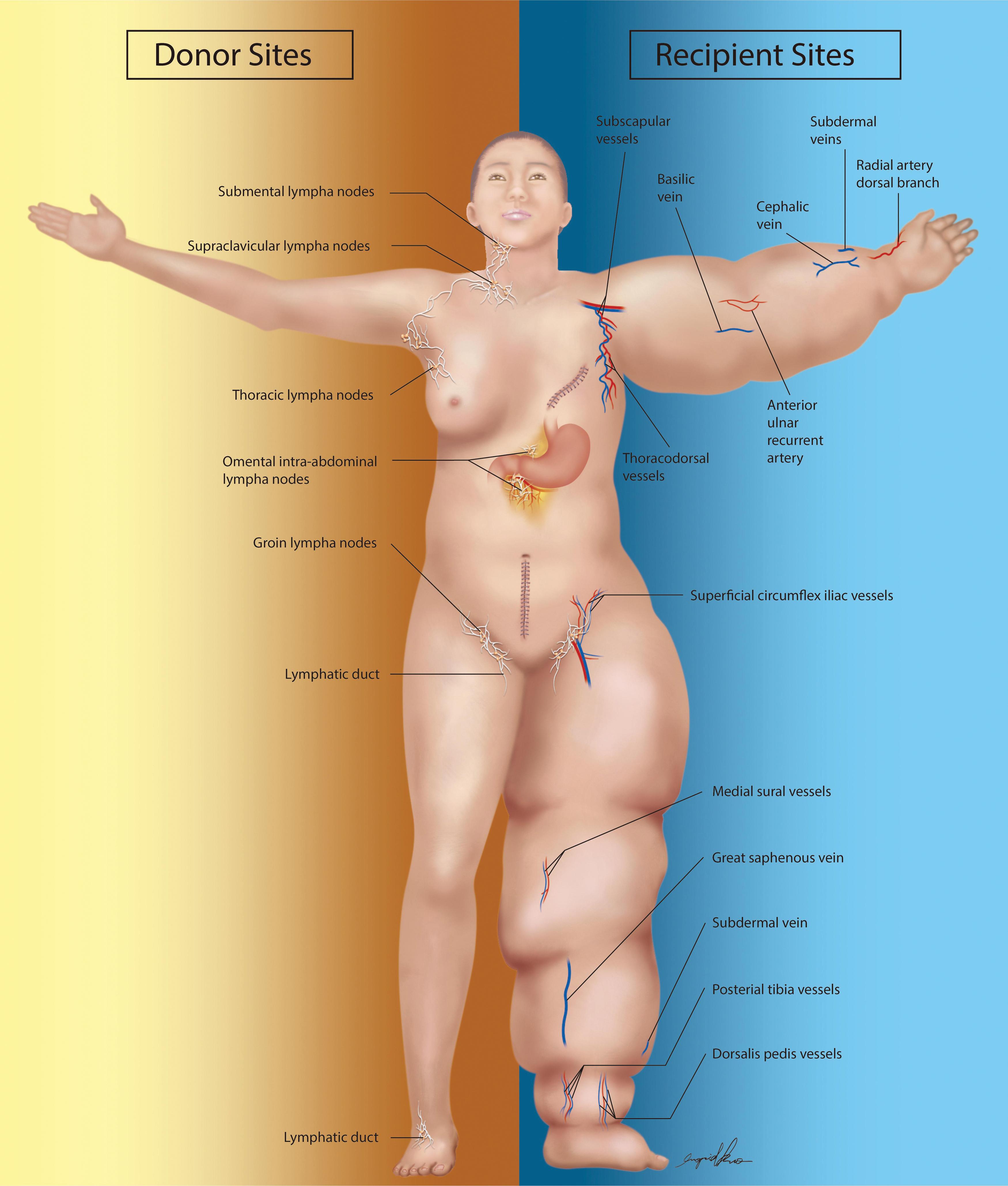 Fig. 27.3, The representative image illustrates both the available donor sites and recipient sites for lymphatic microsurgery procedures.