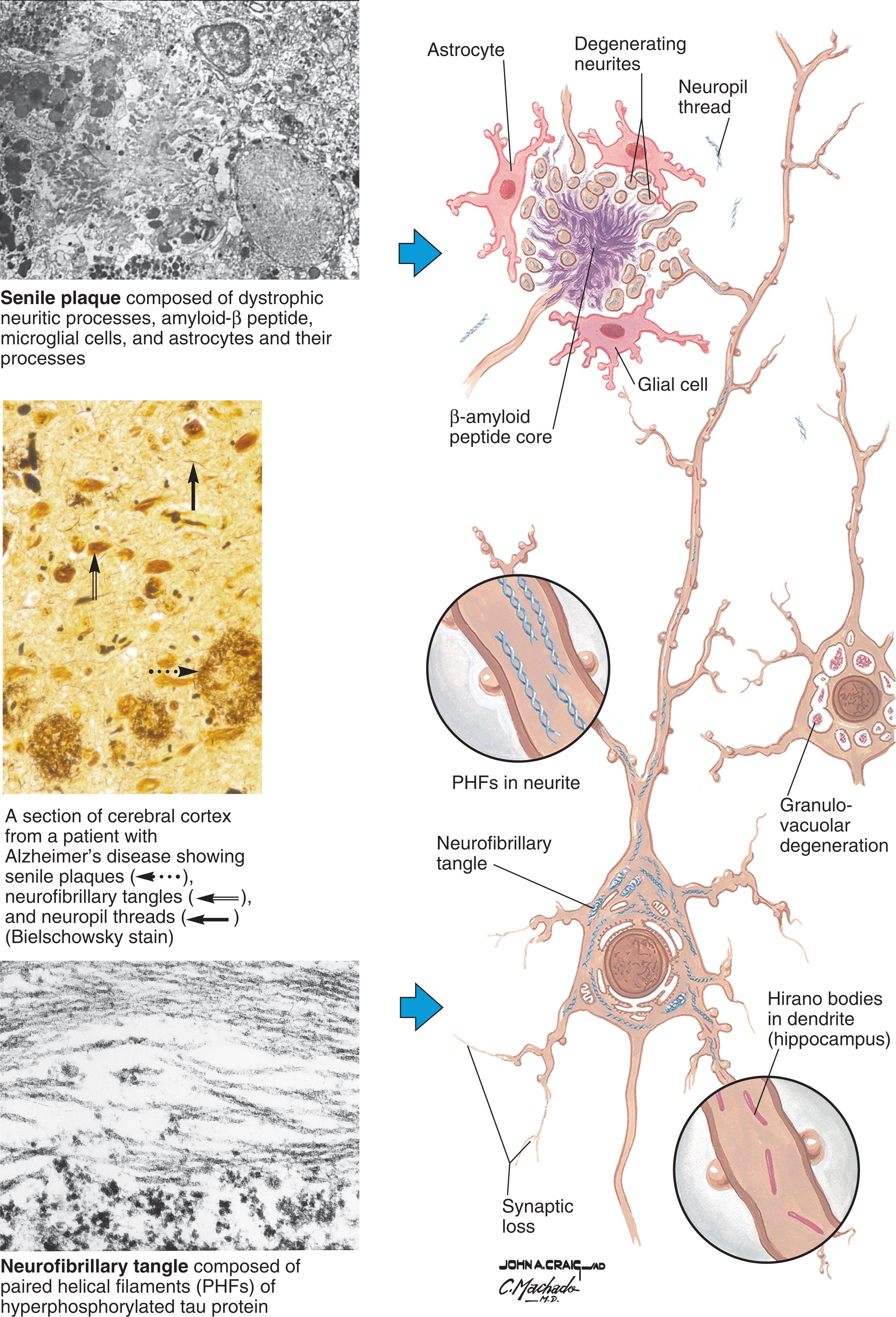 Fig. 23.2, Microscopic pathology in Alzheimer’s disease.