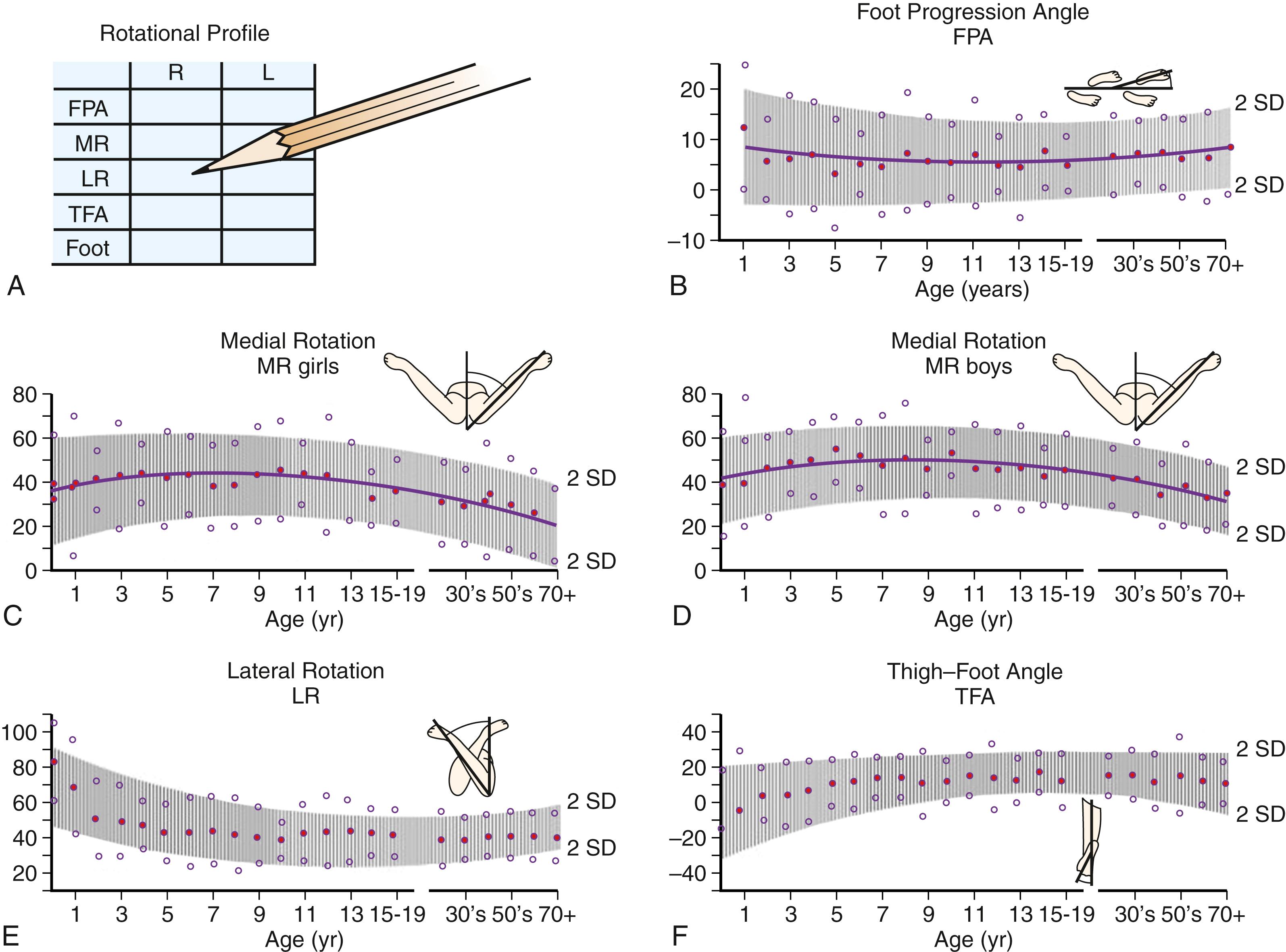 Fig. 45.2, The torsional or rotational profile from birth to maturity. A, The rotational profile is assessed and tracked at each visit. B, Mean foot progression angle (FPA) by age. C, Mean femoral medial rotation in girls by age. D, Mean femoral medial rotation in boys by age. E, Mean lateral rotation by age. F, Mean thigh-foot angle. All graphs include 2 standard deviations from the mean.