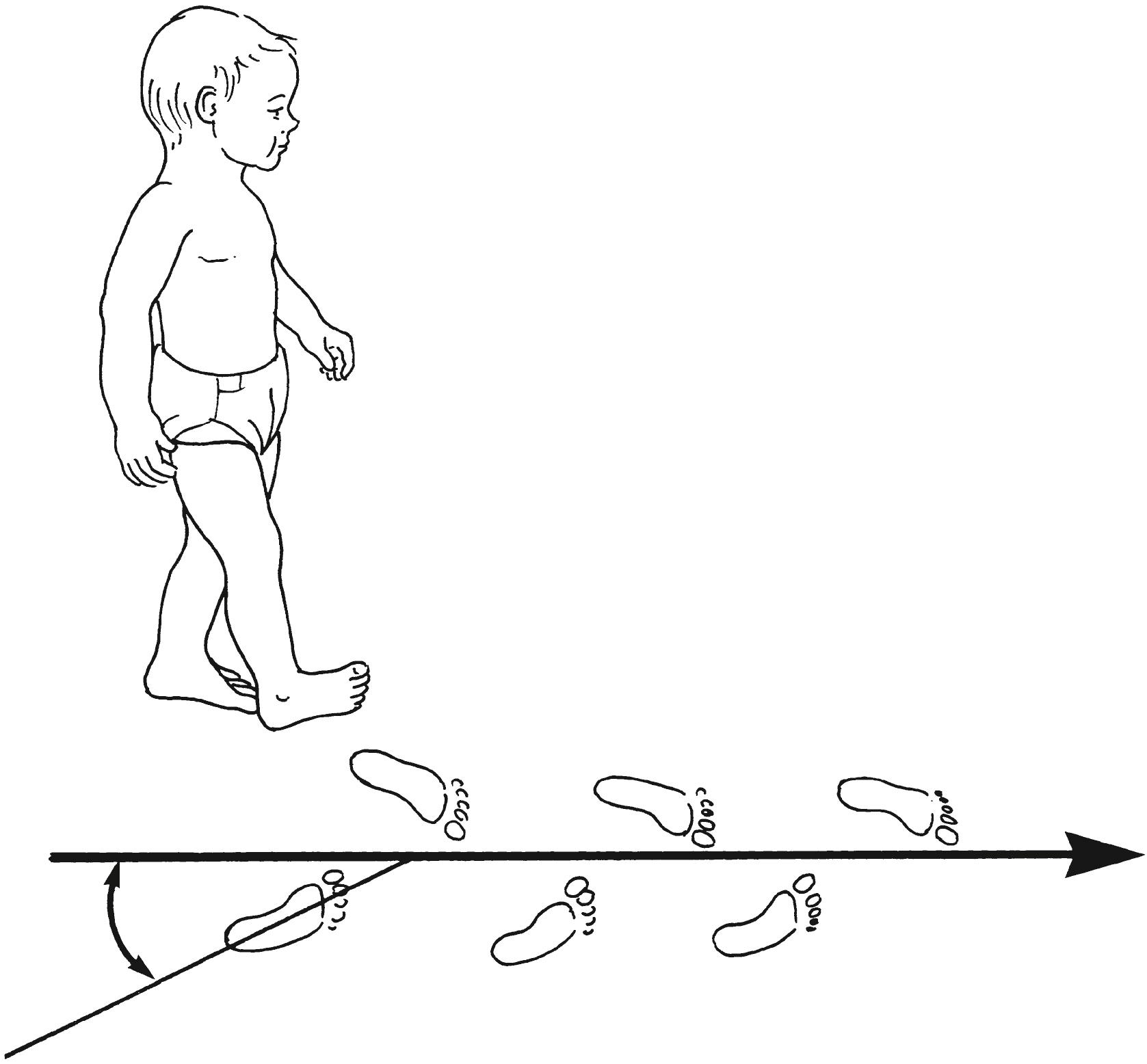 Fig. 45.3, Foot progression angle. The long axis of the foot is compared with the direction in which the child is walking. If the foot points outward, the angle is positive. If the foot points inward, the angle is negative.
