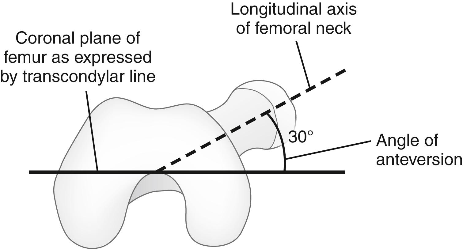Fig. 45.4, Femoral version. Typically, the femoral neck creates an anteriorly directed angle with the transcondylar axis of the distal femur.