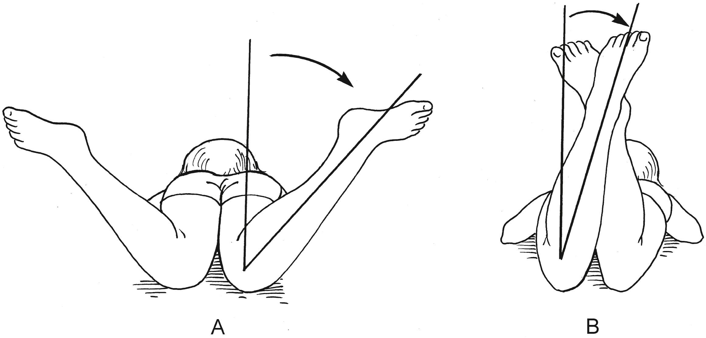 Fig. 45.5, Hip rotation in extension. The child is in the prone position, with the knees flexed 90 degrees. The lower leg is vertically oriented. This is considered the neutral position. Outward rotation (A) of the leg produces internal hip rotation; inward rotation (B) produces external hip rotation.