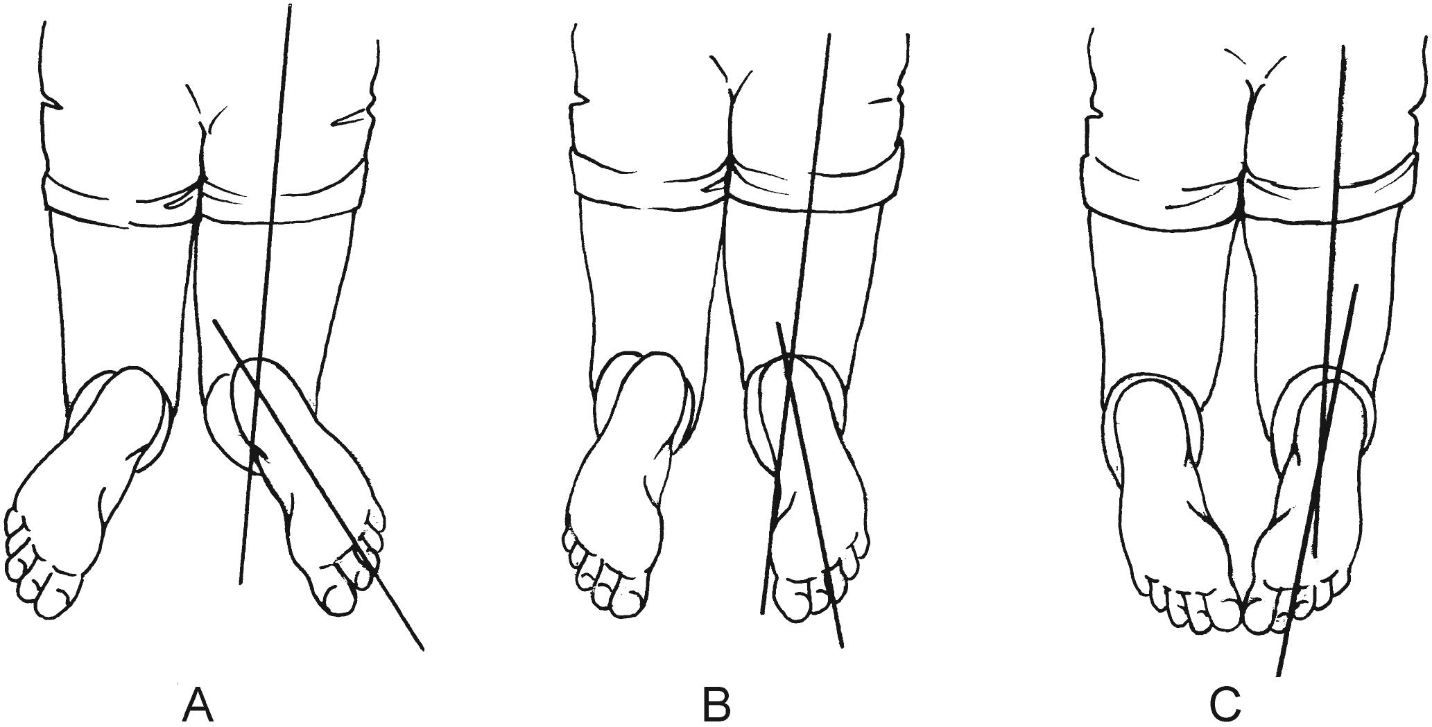 Fig. 45.6, Thigh-foot angle. With the child in the prone position and the knees flexed and approximated, the long axis of the foot can be compared with the long axis of the thigh. The long axis of the foot bisects the heel and the third or middle toe. A, External tibial torsion produces excessive outward rotation. B, Normal alignment is characterized by slight external rotation. C, Internal tibial torsion produces inward rotation.