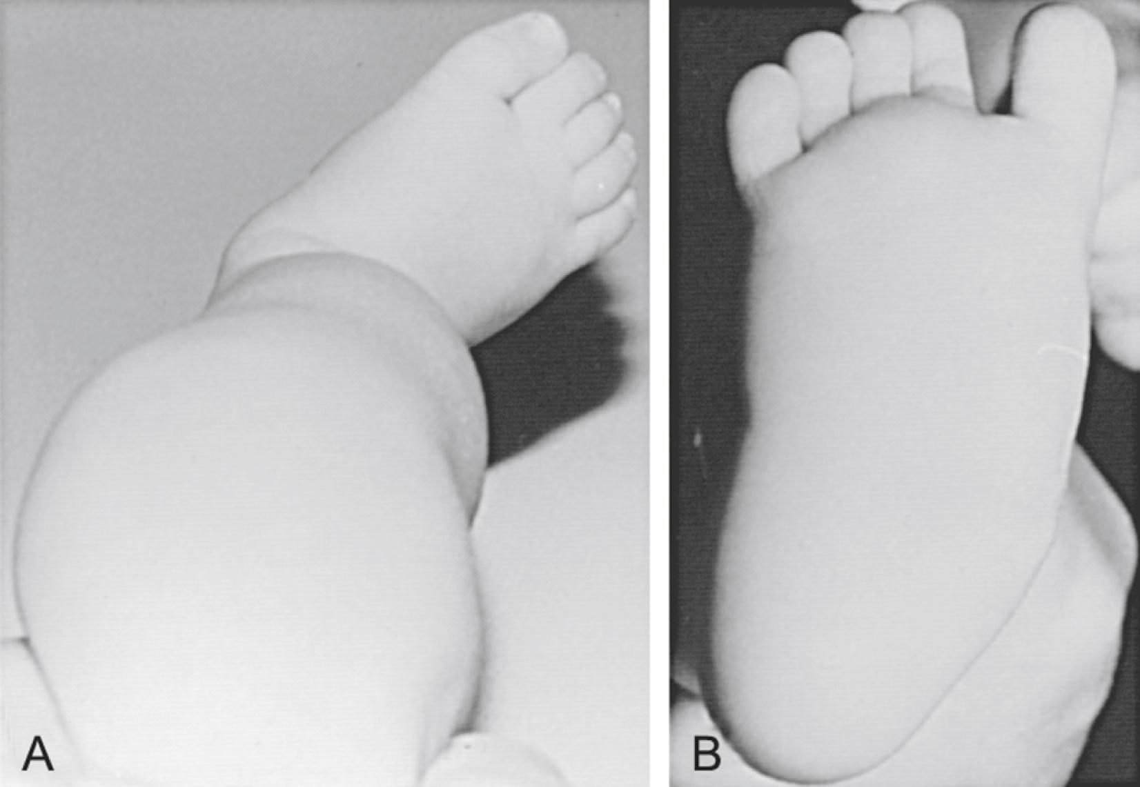 Fig. 45.10, A, A clinical photograph of a 2-month-old girl demonstrating excessive external tibial torsion. This reverse or anterior thigh-foot angle shows approximately 50 degrees of external tibial torsion. B, A calcaneovalgus foot with forefoot abduction and increased hindfoot valgus in the same infant. There is also hyperdorsiflexibility of the foot in the ankle.