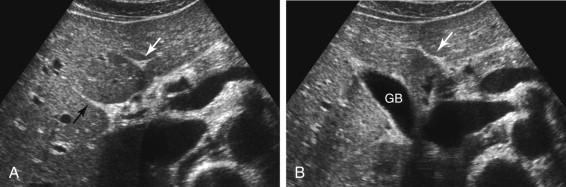 F igure 2-1, Relationship of gallbladder (GB) to interlobar fissure. A, Transverse view of the liver shows the ligamentum teres (white arrow) and the interlobar fissure (black arrow). B, Transverse view slightly inferior to A shows the GB located immediately inferior to the interlobar fissure.