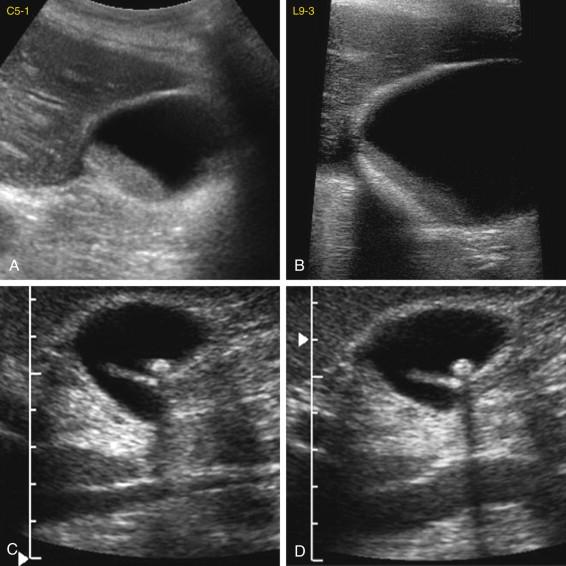 F igure 2-10, Importance of technical parameters in demonstrating gallstone shadowing in different patients. A and B, Transverse view of the gallbladder obtained at 5 to 1 MHz (A) shows echogenic material layering in the gallbladder but no shadowing, whereas a similar view obtained at 9 to 3 MHz (B) shows readily detectable shadowing. C and D, View of the gallbladder with the focal zone placed at the deep aspect of the field of view (C) shows only faint acoustic shadowing from the gallstone, whereas another view with the focal zone placed at the level of the gallstone (D) shows distinct acoustic shadowing.