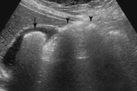 F igure 2-11, Atypical stone with dirty shadowing (arrow). Adjacent gas-filled bowel loops (arrowheads) also show dirty shadowing.