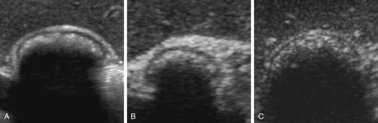 F igure 2-12, Typical examples of the wall–echo–shadow complex in different patients. The complex varies from a very distinct series of arc-shaped lines ( A and B ) to less distinct lines (C) .