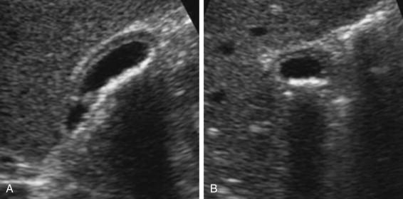 F igure 2-13, Small layering stones. A, Longitudinal view of the gallbladder shows an echogenic deep wall caused by a thin layer of small stones. Posterior shadowing is present but is not easy to perceive. B, Transverse view shows similar findings but the shadow is more obvious and the diagnosis of stones is easier.