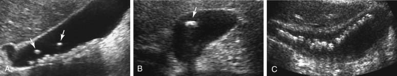 F igure 2-14, Floating stones in different patients. A, Multiple layering of stones in the dependent portion of the gallbladder contrast to two stones floating in the nondependent portion of the lumen (arrows). B, A single floating stone is present in the middle of the gallbladder (arrow). C, Multiple floating stones. In such a case, the location and orientation of the transducer are important in determining what is dependent and confirming that the stones are truly floating.