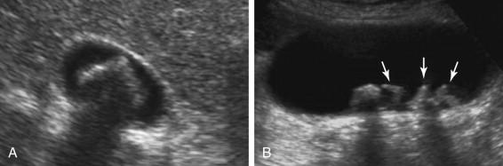 F igure 2-15, Faceted stones in different patients. A, A single large stone with angular margins. B, Multiple smaller stones with angular margins (arrows).