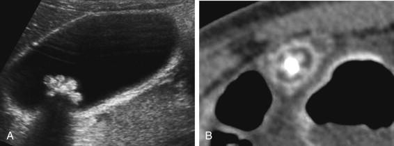 e -F igure 2-2, Jack stone. A, Longitudinal view of the gallbladder shows a gallstone shaped like a jack. B, CT scan shows similar findings.