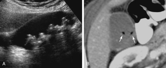 e -F igure 2-3, Gas-containing stones. A, Longitudinal view shows several faceted stones. There is no clue on the sonogram that these stones contain gas. B, CT scan shows small collections of gas within otherwise occult stones.