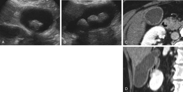 F igure 2-16, Cholesterol stones not visible on CT. A and B, Transverse and longitudinal ultrasound views show multiple large gallstones. C and D, Stones are not visible on transverse and sagittal CT images.