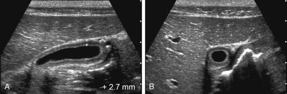 F igure 2-2, Contracted gallbladder. A, Magnified longitudinal view shows a contracted gallbladder with a lumen that measures less than 3 × 1 cm. This makes the wall appear thick, although it measures only 2.7 mm. B, Corresponding transverse view. Both views show the echogenic mucosal layer and the hypoechoic muscular layer.