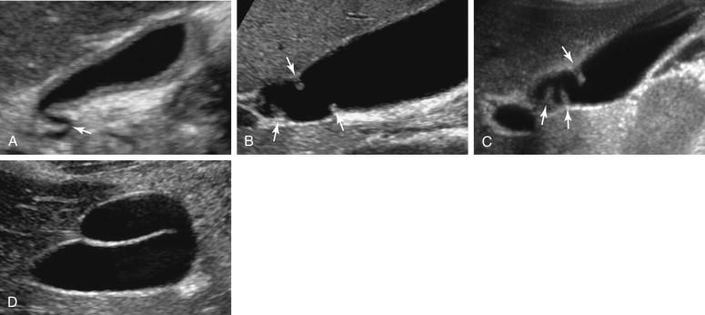 F igure 2-3, Gallbladder folds in different patients. A, Typical junctional folds near the gallbladder neck. B, Subtle folds in the neck of the gallbladder. C, Larger folds in the gallbladder neck. D, Typical Phrygian cap in the fundus of the gallbladder.