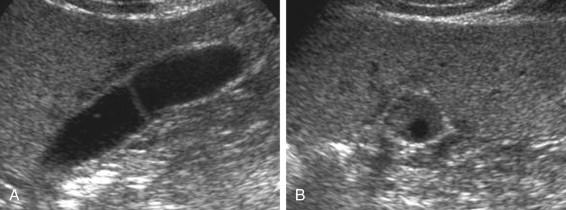 F igure 2-4, Septated gallbladder. A, Longitudinal view shows a thin septation in the body of the gallbladder with little deformation of the outer gallbladder contour. B, Transverse view through the septation shows a small, round defect in the periphery of the septation that allows for communication between the two segments of the gallbladder.