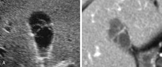 e -F igure 2-1, Septated gallbladder. A, Transverse view shows several connecting septations in the body of the gallbladder. B, Similar findings are seen on CT.