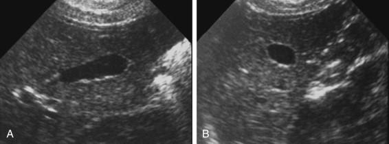 F igure 2-5, Intrahepatic gallbladder. A, Longitudinal view of the liver shows a gallbladder completely surrounded by hepatic parenchyma. B, Transverse view of the gallbladder shows similar findings.