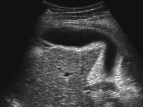 F igure 2-6, Ectopic gallbladder. Longitudinal view of the right upper quadrant in a patient with a small liver due to cirrhosis. The gallbladder body and fundus are interposed between the liver and the abdominal wall.