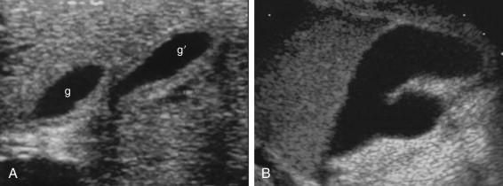 F igure 2-7, Gallbladder duplication in different patients. A, Complete duplication of the gallbladder into two separate structures (g, g′). B, Partial duplication of the gallbladder into two separate fundal segments.