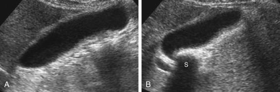 F igure 2-8, Importance of visualizing the entire gallbladder neck. A, Longitudinal view of the gallbladder shows an apparently stone-free lumen. B, Longitudinal view showing more of the gallbladder neck demonstrates a shadowing stone (S) within a folded segment of the gallbladder neck.