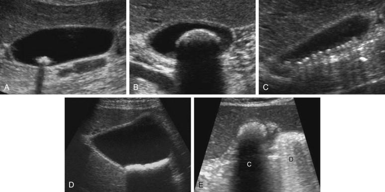 F igure 2-9, Gallstones in different patients. A, Typical small stone with distinct clean acoustic shadow. B, Large stone. Note that the superficial surface of the stone is seen but absorption of the sound precludes visualization of the deeper aspect of the stone. C, Multiple small stones layering in the dependent portion of the gallbladder. D, Very small stones layering in the dependent portion of the gallbladder. E, Gallstone with a clean acoustic shadow (C) immediately adjacent to a gas-filled loop of bowel with a dirty acoustic shadow (D).