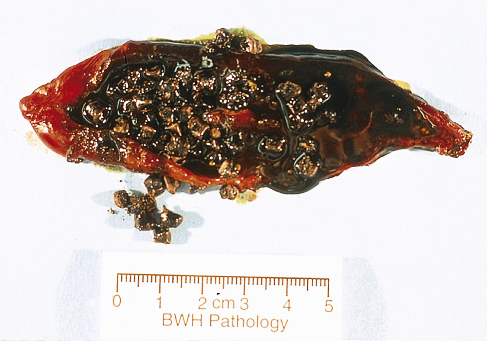 FIGURE 34.5, The pigment gallstones in an opened gallbladder are black, small, and numerous, and they do not have a uniform shape.