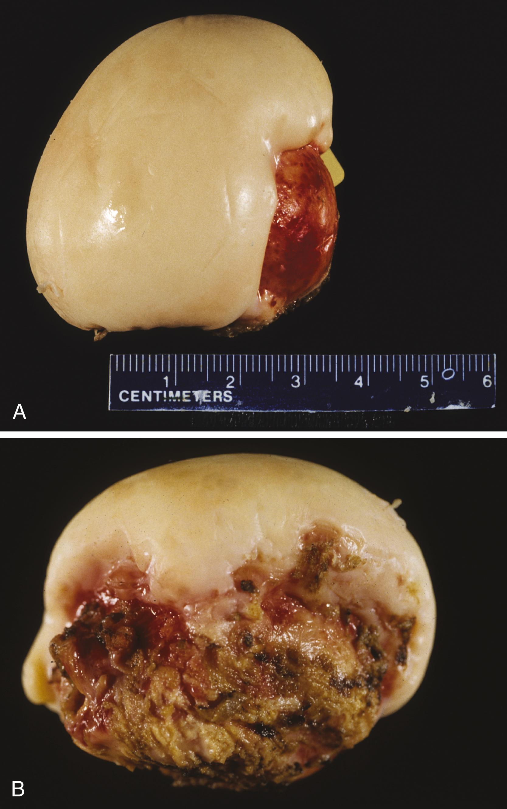 FIGURE 34.6, Porcelain gallbladder.