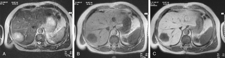 Figure 58-1, Liver metastases from colon carcinoma. Spin echo T2-weighted magnetic resonance image (A) shows a hyperintense lesion with central necrotic changes. Gradient recalled echo T1-weighted images before (B) and after (C) administration of mangafodipir trisodium. After administration of the contrast agent there is an increase of the contrast ratio owing to the lack of uptake of the agent by the lesion.