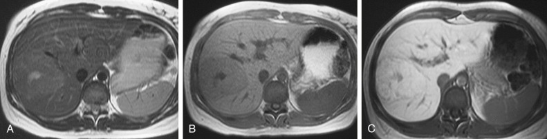 Figure 58-2, Focal nodular hyperplasia. Spin echo T2-weighted magnetic resonance (MR) image (A) shows a hyperintense lesion with a central scar. Gradient recalled echo T1-weighted MR images before (B) and after (C) administration of mangafodipir trisodium. After administration of the contrast agent the lesion is hyperintense with a decrease of the contrast ratio owing to uptake of the agent by the lesion.