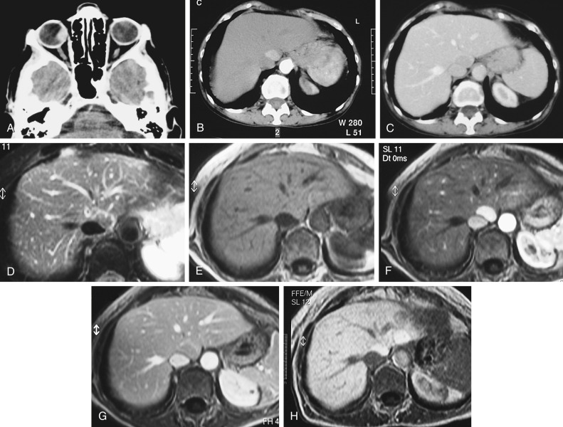 Figure 58-3, Atypical focal nodular hyperplasia in a patient with melanoma. A, On computed tomography (CT) a lesion compatible with melanoma is visible in the right eye. B and C, CT of the liver—arterial (B) and portal (C) phases—shows a hypervascular lesion with washout in the portal phase in the caudate lobe that is suggestive of liver metastasis from melanoma. D to H, On magnetic resonance imaging the lesion is isointense both on T2-weighted (D) and unenhanced T1-weighted gradient recalled echo (E) images. During dynamic imaging after injection of gadobenate dimeglumine, the lesion is hypervascular on the arterial phase (F), with washout in the portal phase (G). At the hepatobiliary phase, 2 hours after the injection (H), both the liver and the lesion are hyperintense owing to contrast uptake.