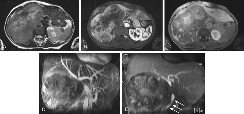 Figure 58-4, Fibrolamellar hepatocellular carcinoma. A, Turbo spin echo T2-weighted image. A large hyperintense lesion with central necrotic changes can be appreciated in the right lobe. B and C, During dynamic imaging after injection of gadobenate dimeglumine, the lesion is hypervascular on the arterial phase (B), with washout in the portal phase (C). The data of the portal phase were reviewed, and maximum intensity projection (MIP) images of the portal vein were generated (D), showing involvement of the main trunk of the portal vein. At the hepatobiliary phase, 2 hours after the injection (E), MIP image shows clear evidence of the main biliary ducts, which appear hyperintense owing to the presence of contrast agent in the bile. The common bile duct is not recognizable at the level of the lesion because of involvement, but the passage of bile in the lower segment is still maintained (arrows).