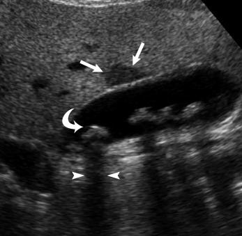 Fig. 17.2, Cholelithiasis/focal fatty sparing of the liver. Scans through the gallbladder demonstrated multiple echogenic foci ( curved arrow ) with acoustic shadowing ( arrowheads ), which are consistent with gallstones. In addition, there is a focal hypoechoic region noted anterior to the gallbladder ( arrows ), which represents an area of focal fatty sparing in a patient with diffuse fatty infiltration of the liver.