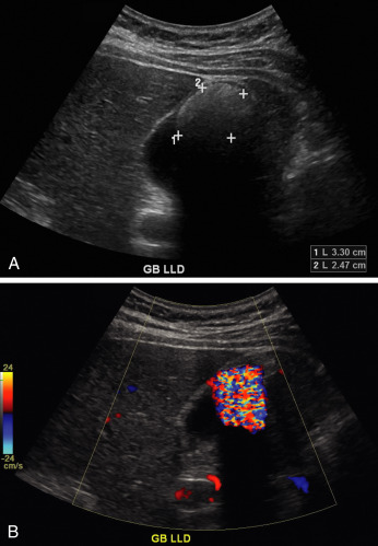 Fig. 17.3, Gallstone with “twinkle” artifact. (A) Large gallstone ( calipers ) in a contracted gallbladder. (B) Color Doppler demonstrates mosaic appearance to the color originating at the anterior surface of the gallbladder, representing the “twinkle” artifact.