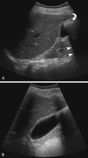 Fig. 17.4, Bowel mimicking gallstones. (A) This longitudinal scan of the liver and gallbladder demonstrates an echogenic focus ( curved arrow ) noted anteriorly within the gallbladder with distal acoustic shadowing ( arrows ). (B) Another scan, using different probe angulation, demonstrates the echogenic focus. This was bowel that moved, and there was no evidence of cholelithiasis.