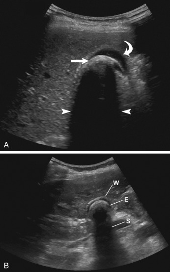 Fig. 17.5, Wall echo shadow (WES) triad. (A) Transverse image demonstrating anterior gallbladder wall ( curved arrow ) and partially collapsed gallbladder surrounding a large gallstone ( arrow ). Posterior to this there is an echogenic focus with acoustic shadowing ( arrow heads ) representing a large gallstone. There is still some fluid within the gallbladder. (B) In another patient, there is a near completely contracted gallbladder with anterior gallbladder wall ( W ) surrounding the gallstone as an echogenicity ( E ) and distal acoustic shadowing ( S ), giving the WES appearance.