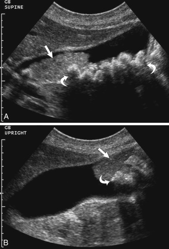 Fig. 17.6, Biliary sludge and cholelithiasis. (A) To the left side of the image there is an echogenic mass ( arrow ) without shadowing within the gallbladder lumen representing gallbladder sludge. To the right, there are multiple echogenic foci ( curved arrows ) with acoustic shadowing, representing gallstones. (B) When the patient is placed in an upright position, this mass ( arrow ) is mobile and falls to the dependent portion of the gallbladder. Note: Multiple echogenicities ( curved arrow ) within this echogenic sludge represent the gallstones.