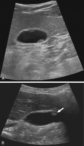 Fig. 17.7, Gallbladder polyps. (A) This image demonstrates an echogenic focus without shadowing ( calipers ) in the dependent portion of the gallbladder, representing a gallbladder polyp. If proper technique was not used, this could be misinterpreted as a gallstone. (B) In another patient, there is an anterior echogenic focus ( arrows ) without acoustic shadowing, representing a gallbladder polyp.