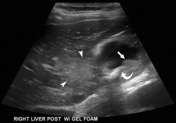 Fig. 17.8, Gallbladder carcinoma. Longitudinal scan of the gallbladder demonstrates a gallstone ( curved arrow ) with a nonmobile mass ( arrow ) in the gallbladder. There is also gallbladder wall thickening. An ill-defined mass ( arrowheads ) in the liver represents local invasion into the liver from the gallbladder adenocarcinoma.