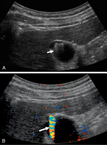 Fig. 17.9, Adenomyomatosis. (A) Transverse scan through the gallbladder demonstrates a few echogenic foci with “ring-down artifact” ( arrow ). Note this is different than in cholelithiasis, where there is acoustic shadowing. (B) In the same region there is “twinkle” artifact ( arrow ), which can be seen with both adenomyomatosis and cholelithiasis.