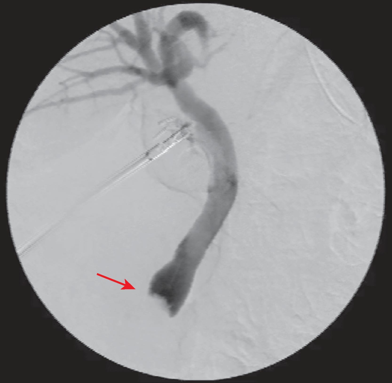 FIG. 2, Intraoperative cholangiogram showing filling of the common bile duct and the left and right hepatic ducts, but absent filling of the duodenum due to a distal stone obstructing the duct, with a meniscus sign (arrow).