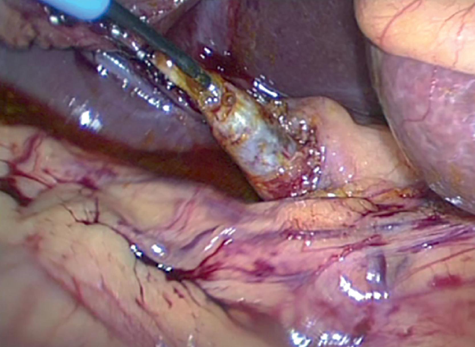 FIG. 3, Balloon dilation of the cystic duct in preparation for transcystic common bile duct exploration and stone extraction. See text for details.