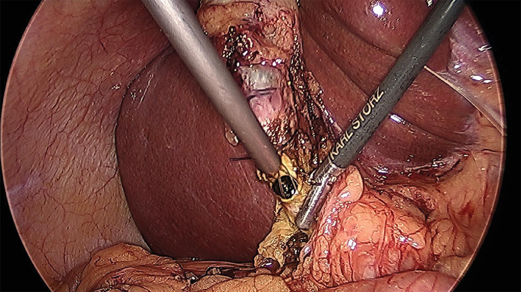 FIG. 4, Transcystic stone extraction with basket.