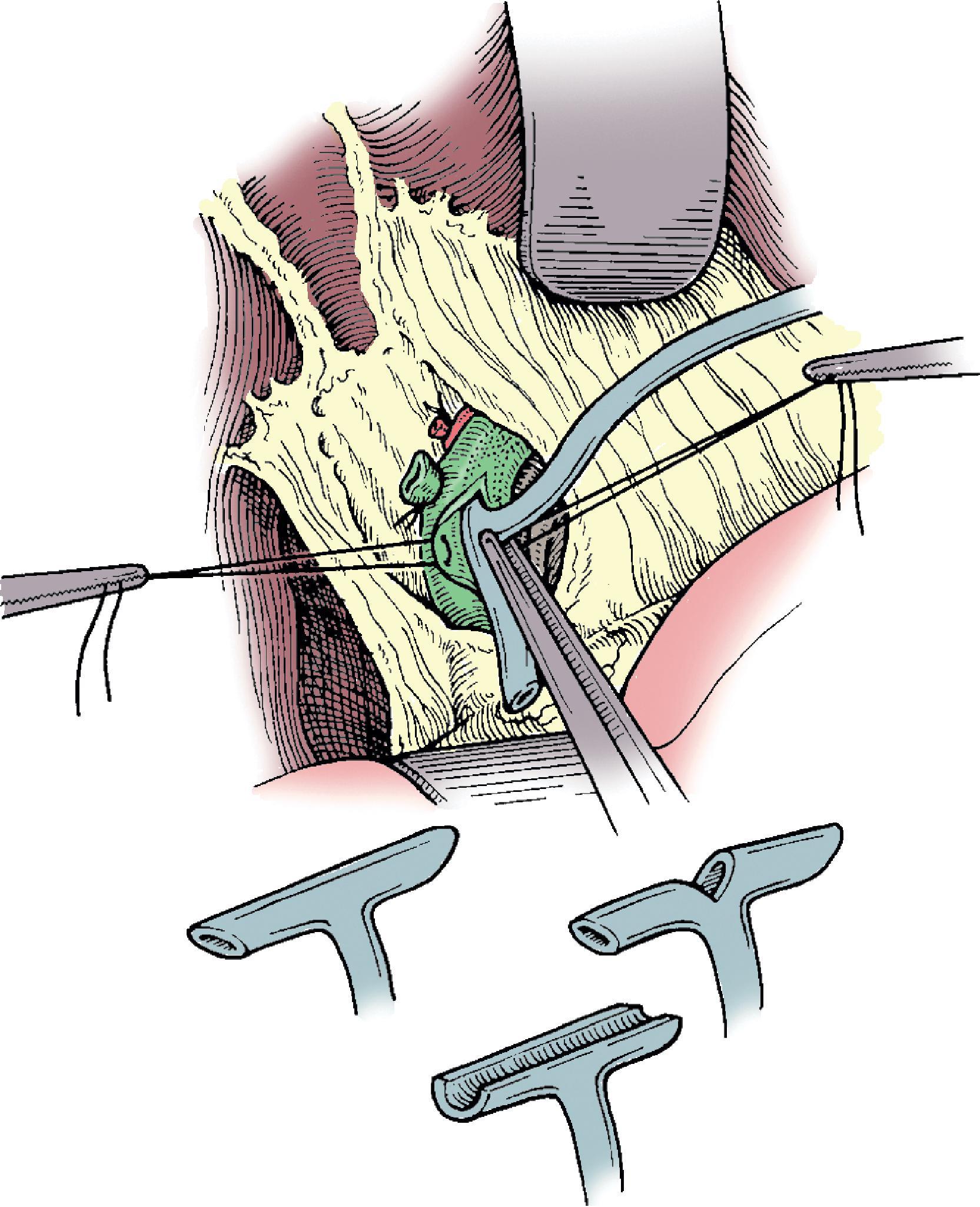 FIG. 5, Closure of the ductotomy over a T-tube. When trimming the T-tube, it is common to excise part or all of the back wall to facilitate extraction. The ductotomy should be closed as described in the text.